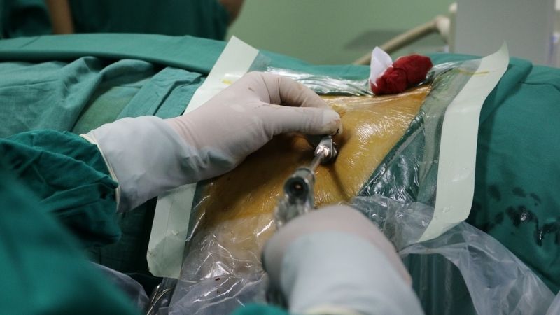 Phẫu thuật dành cho những bệnh nhân gai cột sống quá nặng