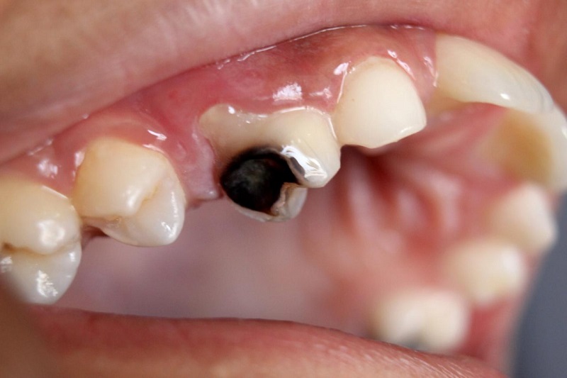 Sự thiếu hụt Calciferol dễ gây ra các vấn đề về răng miệng