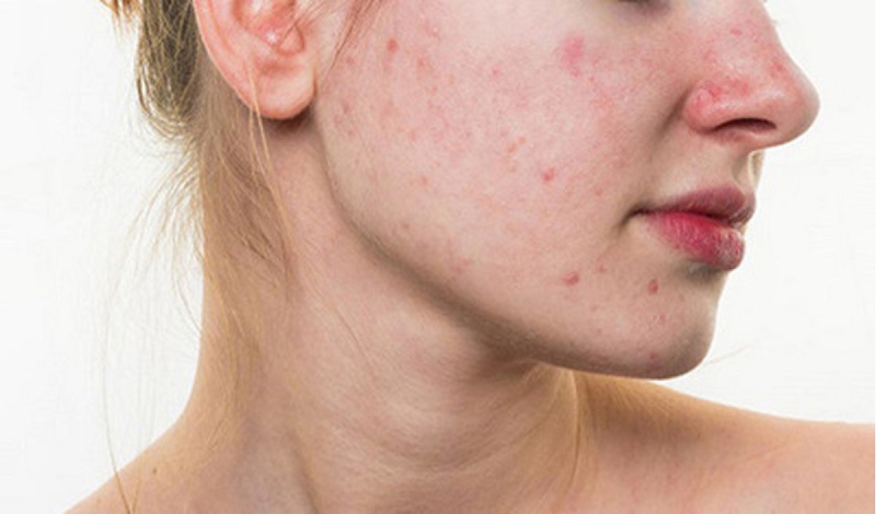 Tự nặn mụn không đảm bảo vệ sinh có thể dẫn đến nhiễm trùng da và để lại sẹo trên mặt