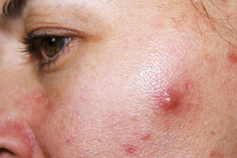Mụn sưng đỏ không nhân là một phản ứng viêm trên da
