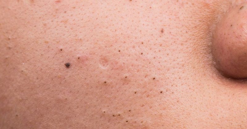 Mụn đầu đen thường xuất hiện do dầu thừa tích tụ trên da hoặc nang lông bị tắc nghẽn trong thời gian lâu