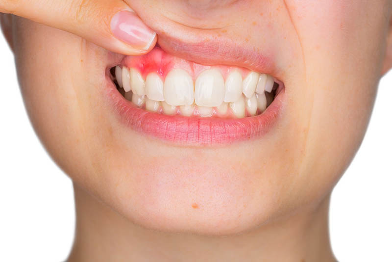 Viêm chân răng là tình trạng khá phổ biến
