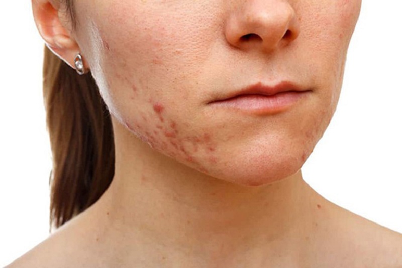 Thâm mụn và sẹo thường xuất hiện sau quá trình da bị tổn thương do mụn