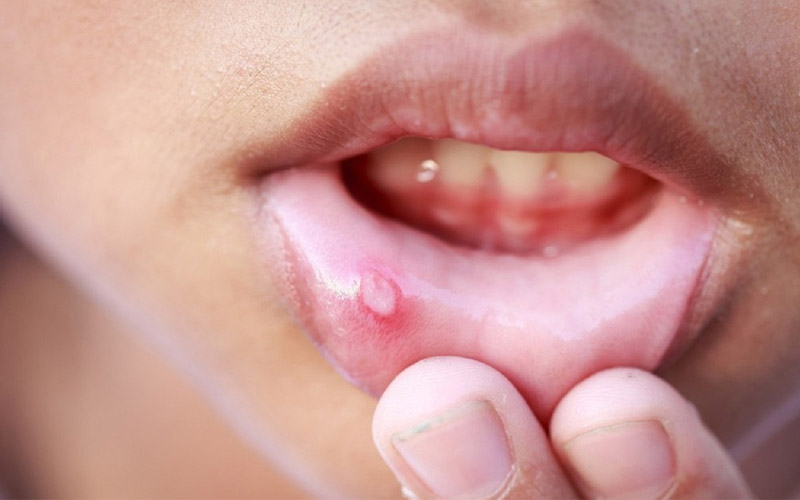 Bệnh nhiệt miệng ở trẻ em do nhiều nguyên nhân khác nhau gây ra