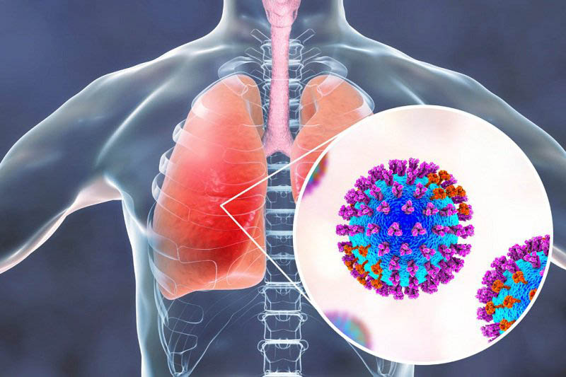 Bệnh viêm phổi là nguyên nhân dẫn đến ho, tức ngực, khó thở