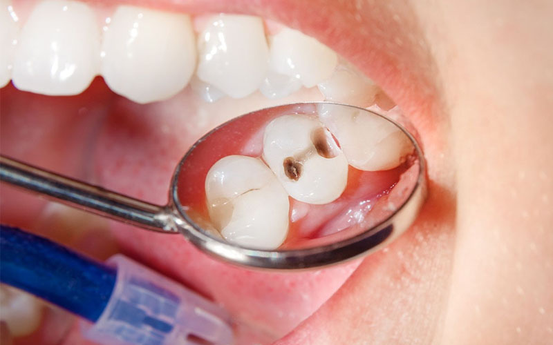Hôi miệng sâu răng là tình trạng khá phổ biến mà rất nhiều người bệnh gặp phải hiện nay