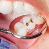 Hôi Miệng Sâu Răng Là Gì Và Những Thông Tin Quan Trọng Cần Biết