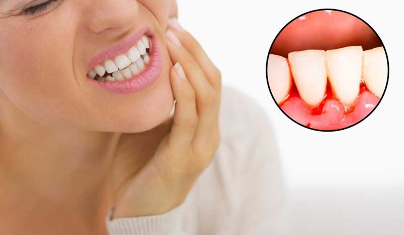 Có nhiều nguyên nhân gây ra nhiệt miệng chảy máu chân răng