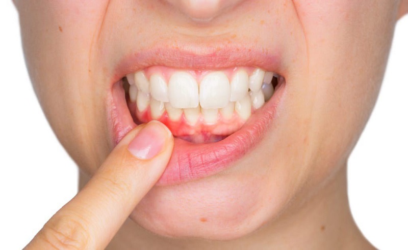 Sưng lợi chảy máu chân răng là tình trạng lợi (nướu) bị tổn thương dẫn đến viêm sưng