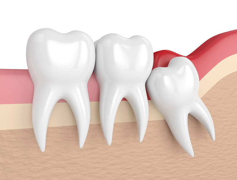 Răng khôn mọc ngầm hay mọc lệch cũng là nguyên nhân dẫn đến việc nướu bị sưng và có mủ