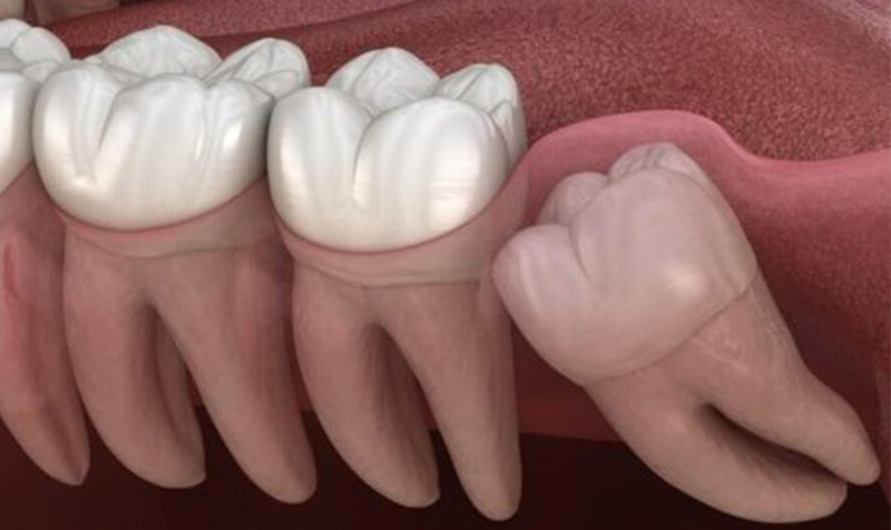 Nướu răng cùng bị sưng có thể do răng khôn mọc lệch