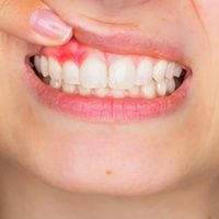 Bệnh Sưng Nướu Răng Và Nổi Hạch: Nguyên Nhân Và Cách Chữa Trị