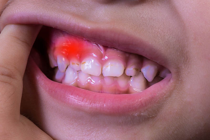 Bé bị viêm lợi cần được chăm sóc răng miệng kỹ lưỡng
