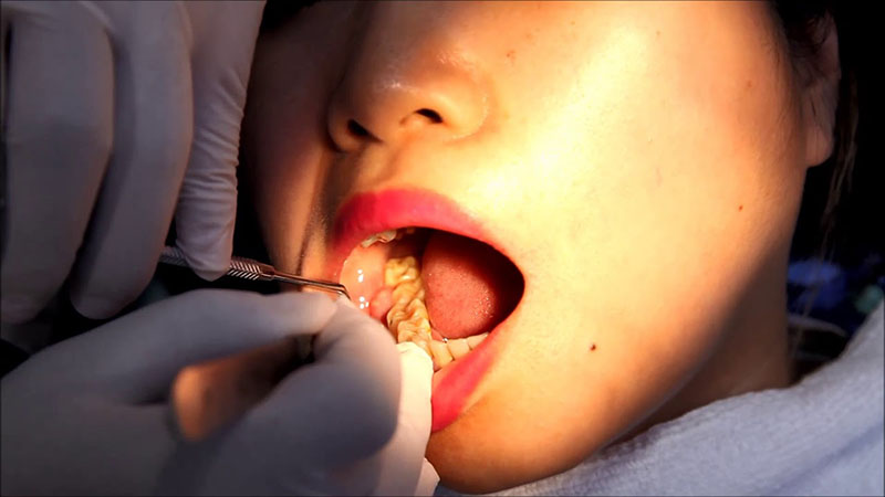Viêm lợi tùm có mủ là hệ quả của việc mọc răng khôn
