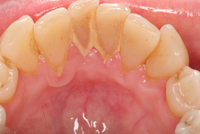 Một trong những nguyên nhân phổ biến gây tụt lợi là do cao răng nhiều