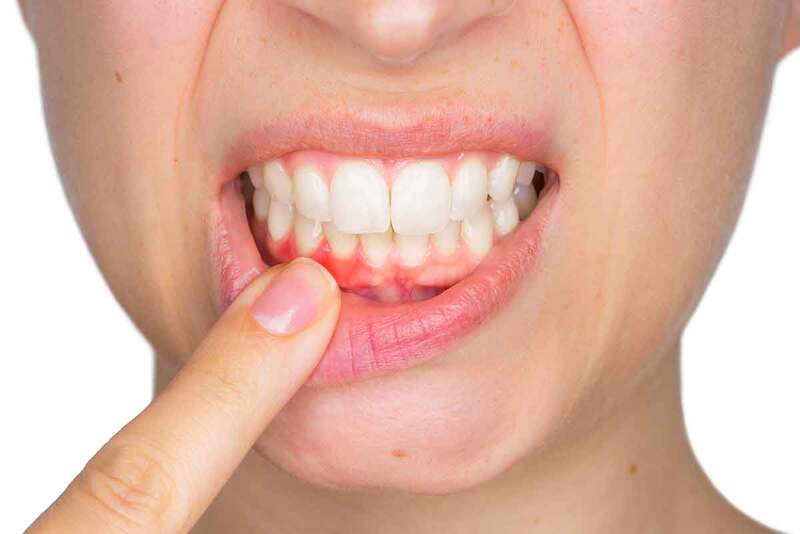 Viêm lợi tụt chân răng nhẹ điều trị dễ dàng hơn