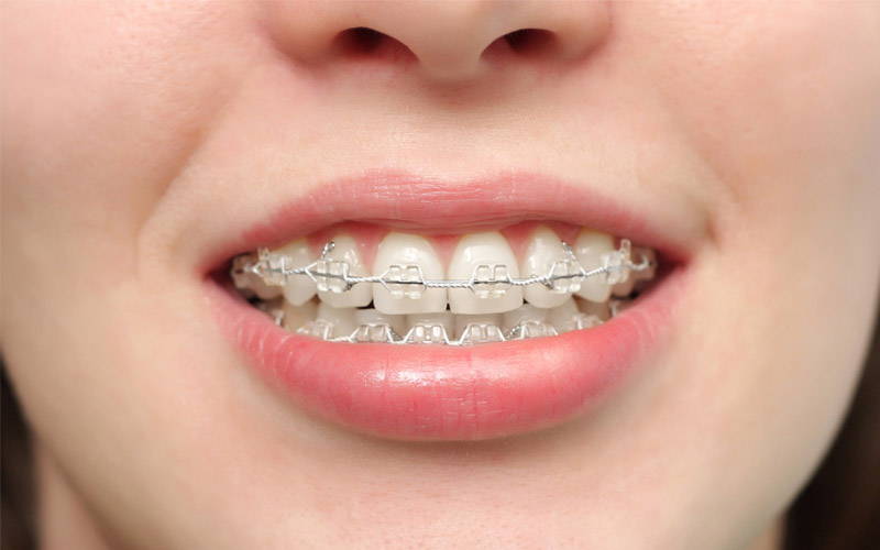 Nhiều người gặp phải tình trạng viêm nha chu khi niềng răng