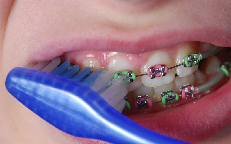 Khi niềng răng, việc vệ sinh răng miệng gặp khó khăn hơn rất nhiều