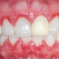Viêm nướu răng sứ: Nguyên nhân và những cách khắc phục hiệu quả