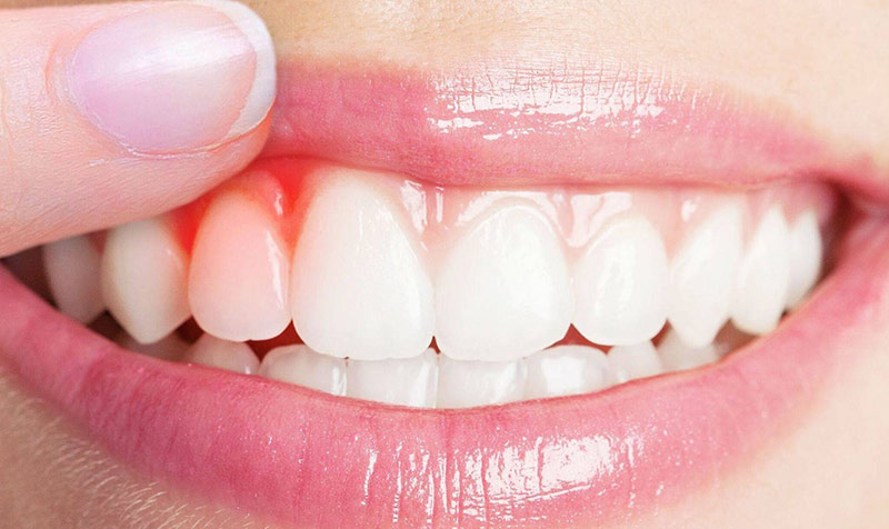 Nướu răng bị sưng sau khi bọc răng sứ sẽ có biểu hiện sưng đỏ, đau nhức 