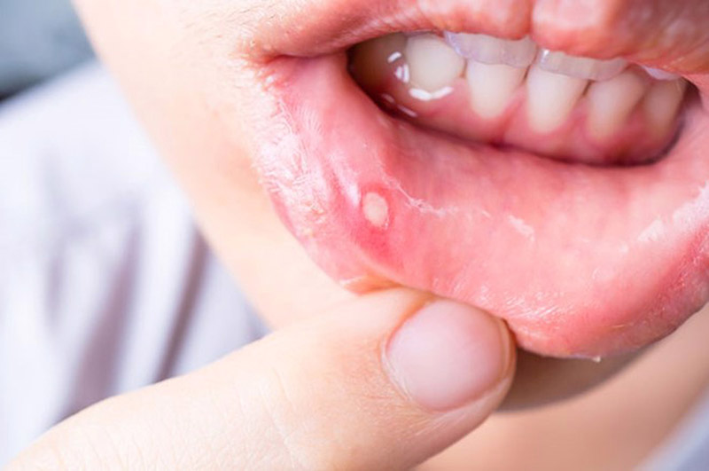 Nhiệt miệng gây ra nhiều khó chịu, ảnh hưởng đến việc ăn uống, sinh hoạt
