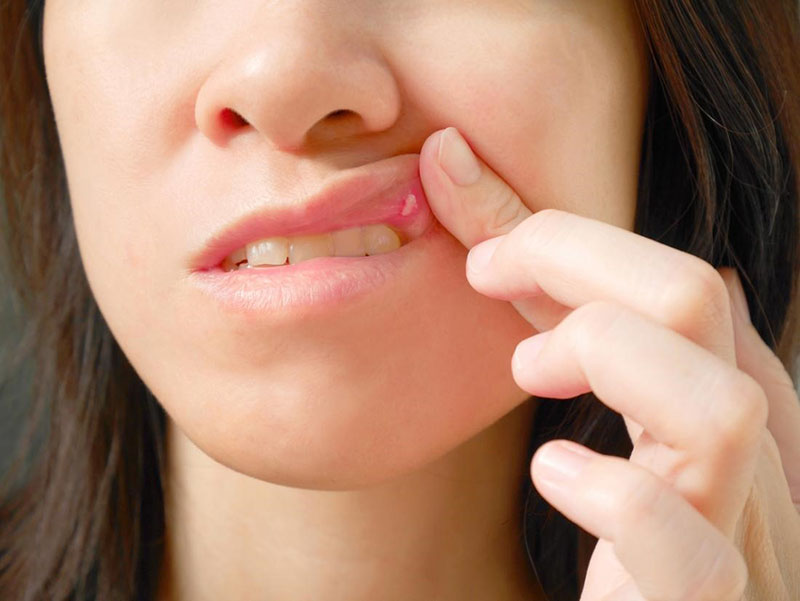 Nhiệt miệng gây ra những vết loét khoảng 1mm gây đau đớn, khó chịu cho người bệnh