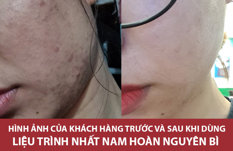 Làn da của chị Thùy đã cải thiện rõ rệt sau khi sử dụng liệu trình thảo dược Nhất Nam Hoàn Nguyên Bì
