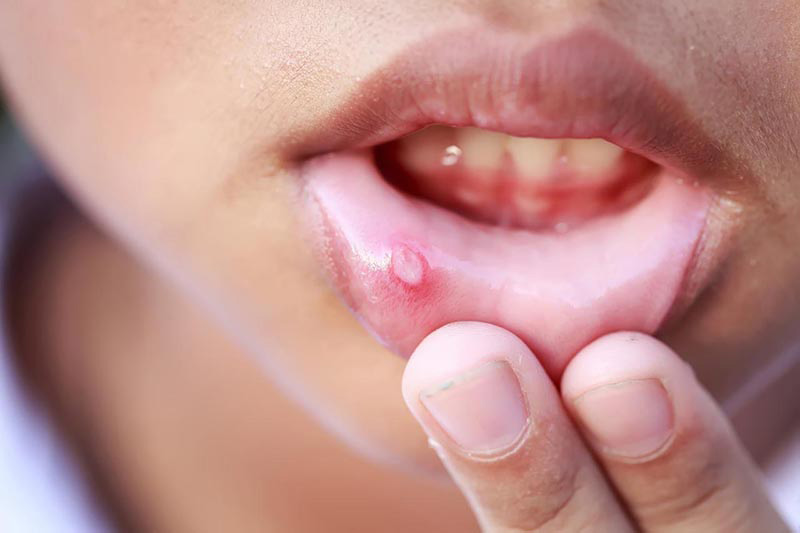 Ít ai biết rằng nhiệt miệng nổi hạch có thể là dấu hiệu cảnh báo cho một số bệnh lý nguy hiểm