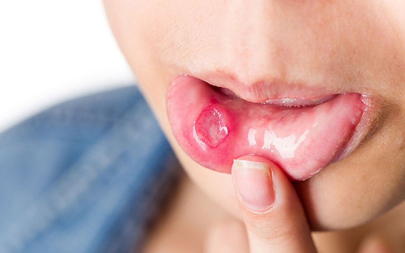 Bệnh nhiệt miệng có thể xuất hiện ở cả người lớn và trẻ nhỏ