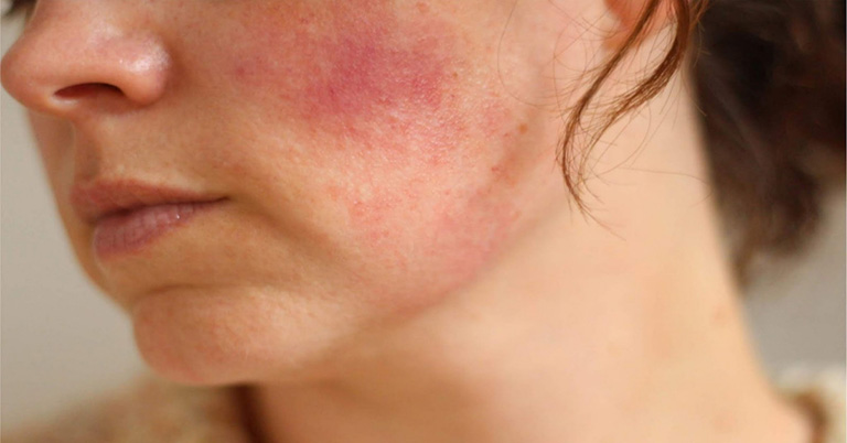 Chàm da là một dạng tổn thương da thường gặp, gây ngứa ngáy rất khó chịu