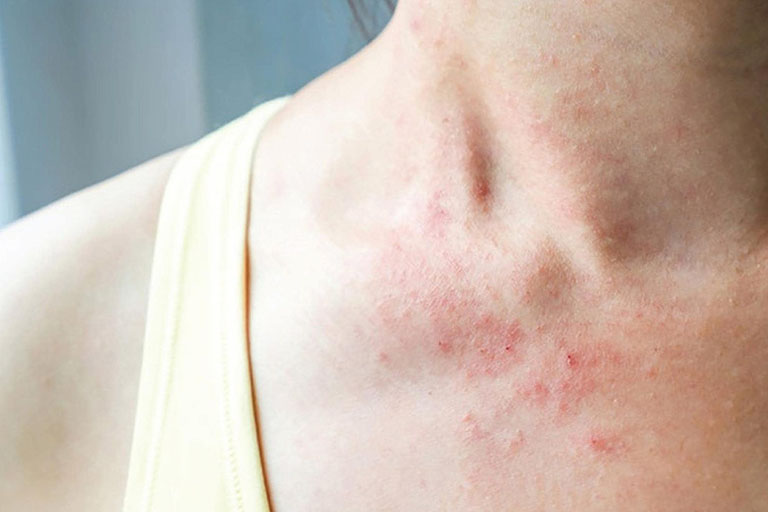 Các triệu chứng của bệnh viêm da dị ứng khiến làn da trông mất thẩm mỹ và ảnh hưởng đến đời sống