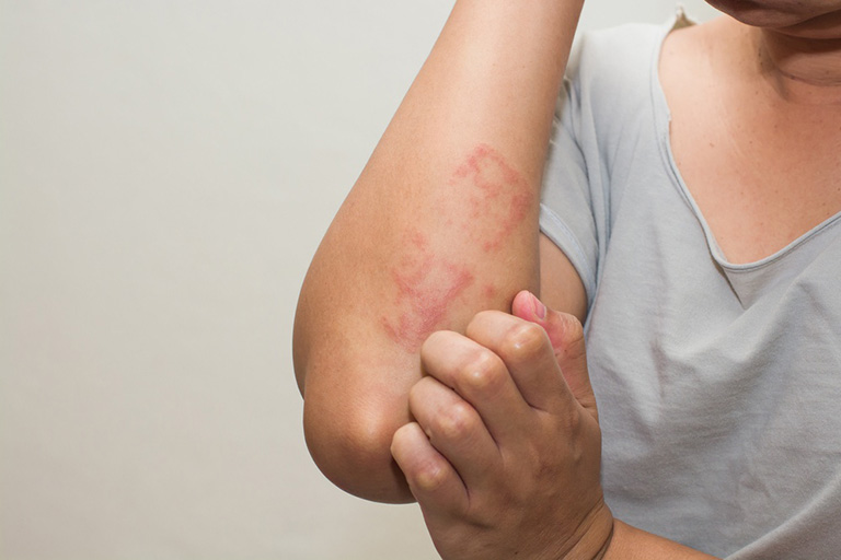 Viêm da tiếp xúc là hiện tượng da bị kích ứng sau khi tiếp xúc với tác nhân gây dị ứng
