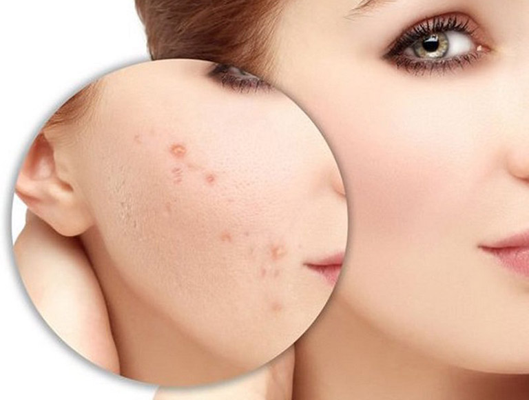 Sẹo sẽ hình thành trên da nếu bạn chăm sóc da không tốt sau khi tẩy nốt ruồi