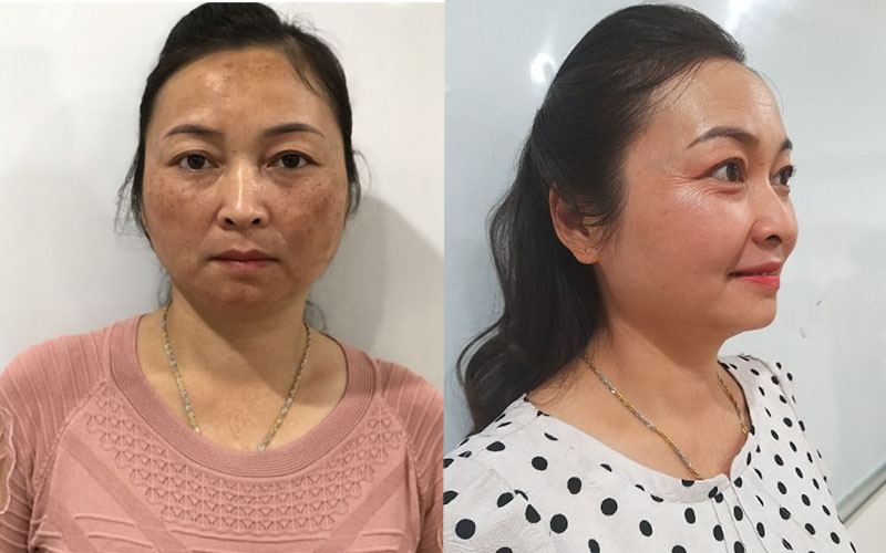 Cô Tạ Thị Vân và làn da sau 2 tháng dùng Vương Phi