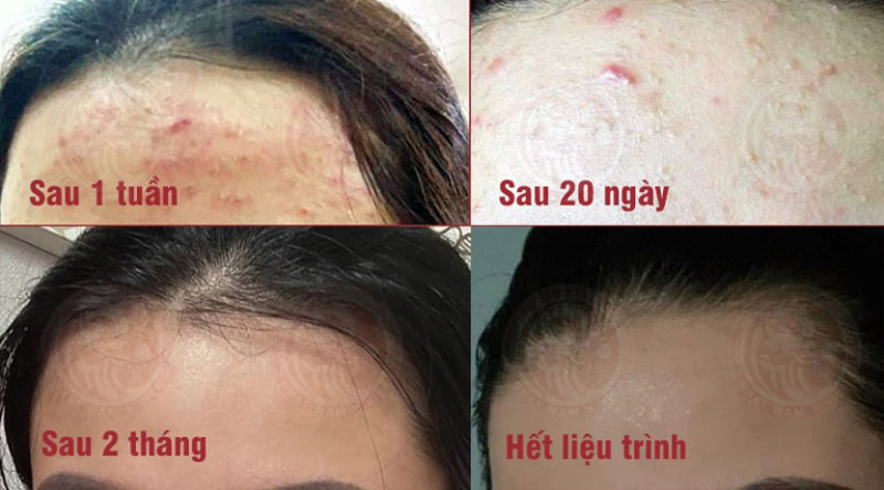 Làn da của chị Khánh Vân trước và sau khi điều trị mụn với Nhất Nam Hoàn Nguyên Bì