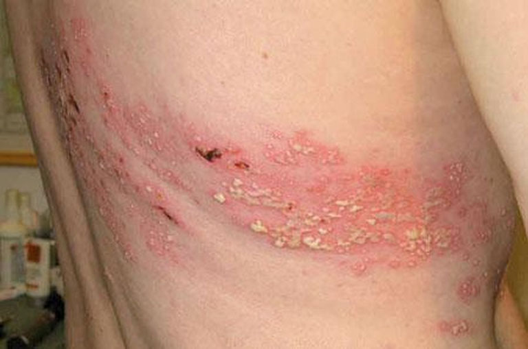 Zona thần kinh khiến làn da bị tổn thương nghiêm trọng và rất dễ bị nhiễm khuẩn