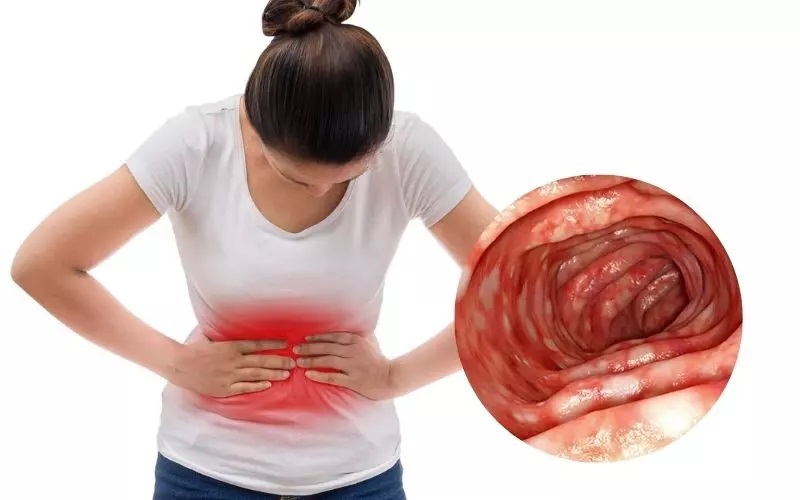 Viêm đại tràng gây đau bụng quặn thắt, tiêu chảy hoặc táo bón