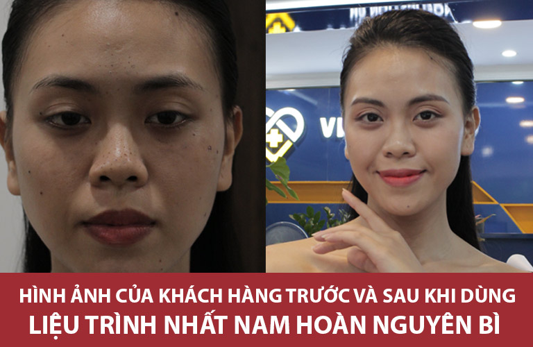 Sau 3 tháng dùng Nhất Nam Hoàn Nguyên Bì, chị Trang đã lấy lại làn da láng mịn