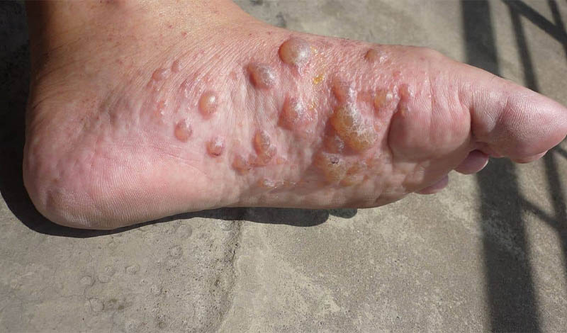 Bệnh tổ đỉa ở tay chân có thể gặp ở bất kỳ đối tượng nào