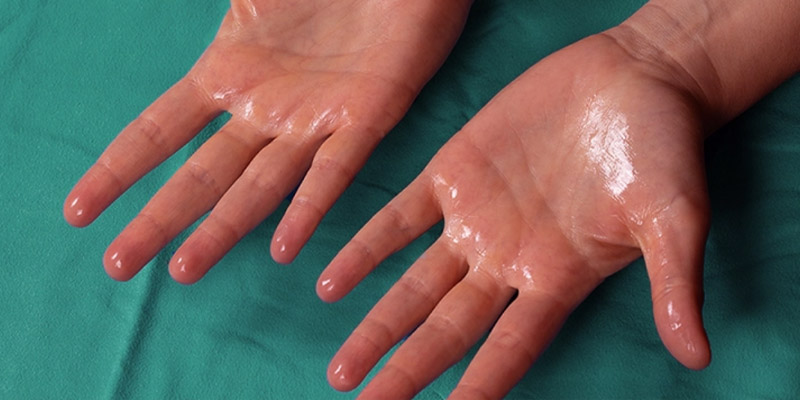 Đổ mồ hôi tay chân là một trong những yếu tố dễ khiến bệnh khởi phát