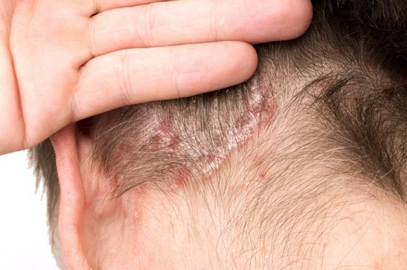 Vảy nến da đầu là hiện tượng các tế bào thượng bì tăng sinh bất thường