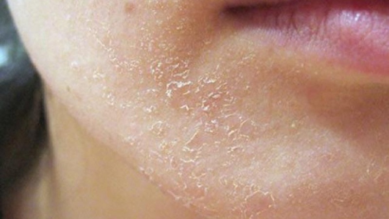 Vảy nến da mặt gây ra nhiều khó chịu cho người bệnh