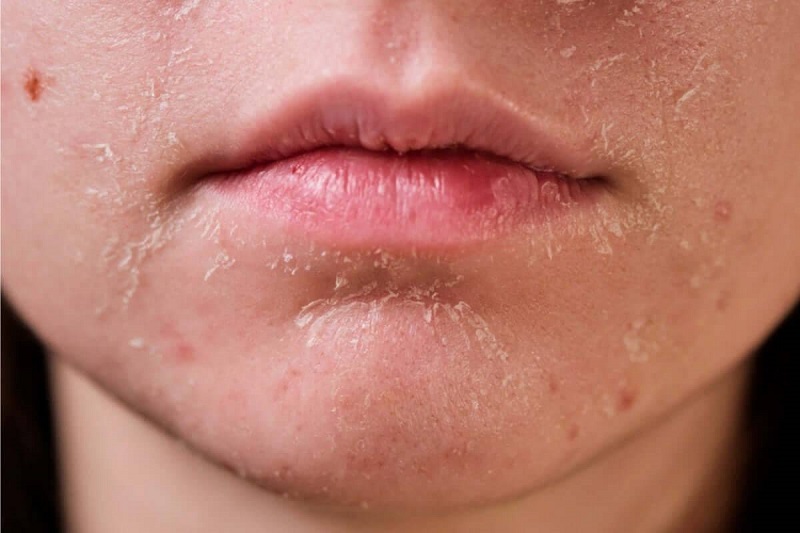 Có rất nhiều nguyên nhân gây bệnh vảy nến da mặt