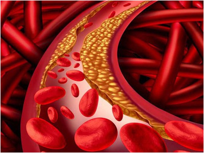 Giảm Cholesterol giúp giảm nguy cơ mắc các bệnh tim mạch