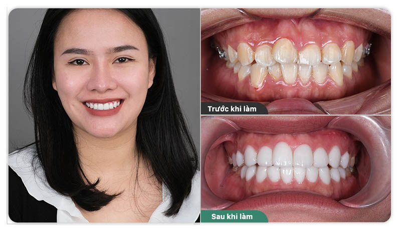 Khách hàng đánh giá cao về kết quả bọc răng sứ tại ViDental Clinic