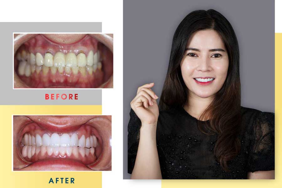 Khách hàng review bọc răng sứ tại ViDental Clinic hiệu quả, chất lượng