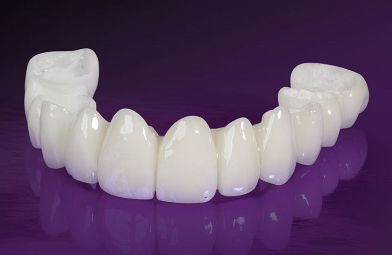 ViDental sử dụng vật liệu bọc răng sứ chất lượng, cao cấp
