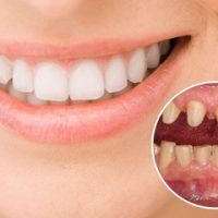Review Bọc Răng Sứ Tại ViDental Clinic Đẹp - Bền - Tiết kiệm