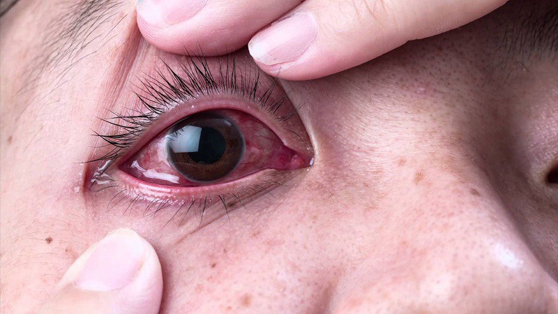 Huyết áp cao gây ra các biến chứng về mắt